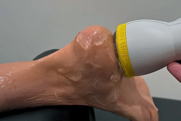 SoftWave Therapy: A Revolutionary New Treatment for Plantar Fasciitis in Yadkin Valley, NC with Dr James Saeli